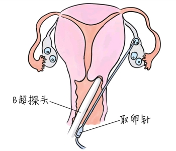 小儿退烧推拿手法 5种苏州捐卵宝宝退烧按摩方法